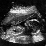 L&rsquo;écographie d&rsquo;un bébé pêcheur